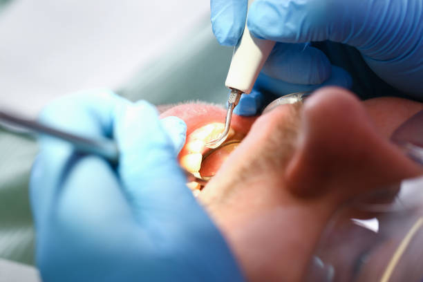 Best Emergency Wisdom Teeth Removal in Burkburnett, TX